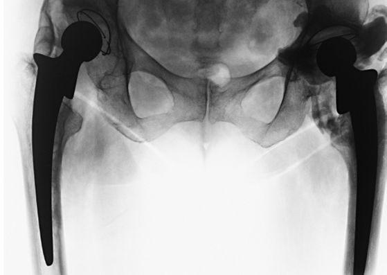 hip brace
