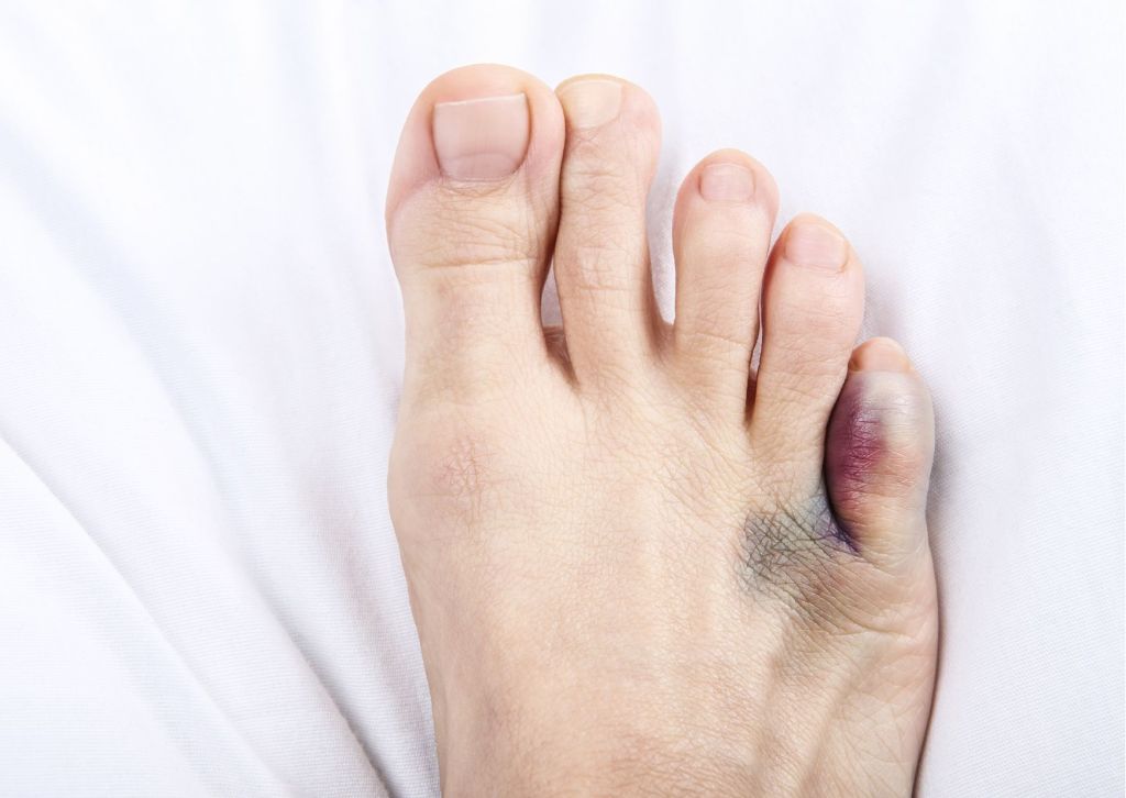 metatarsal fractures