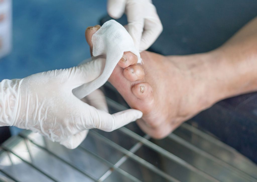 metatarsal fracture	