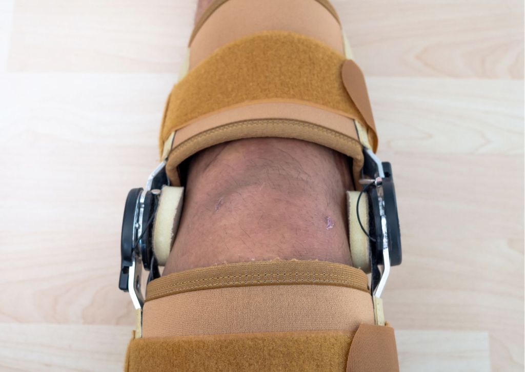 patella fracture